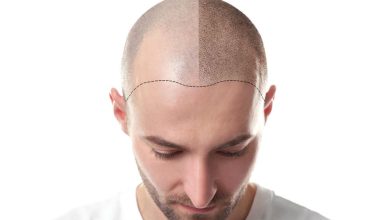 FUE Hair Transplant