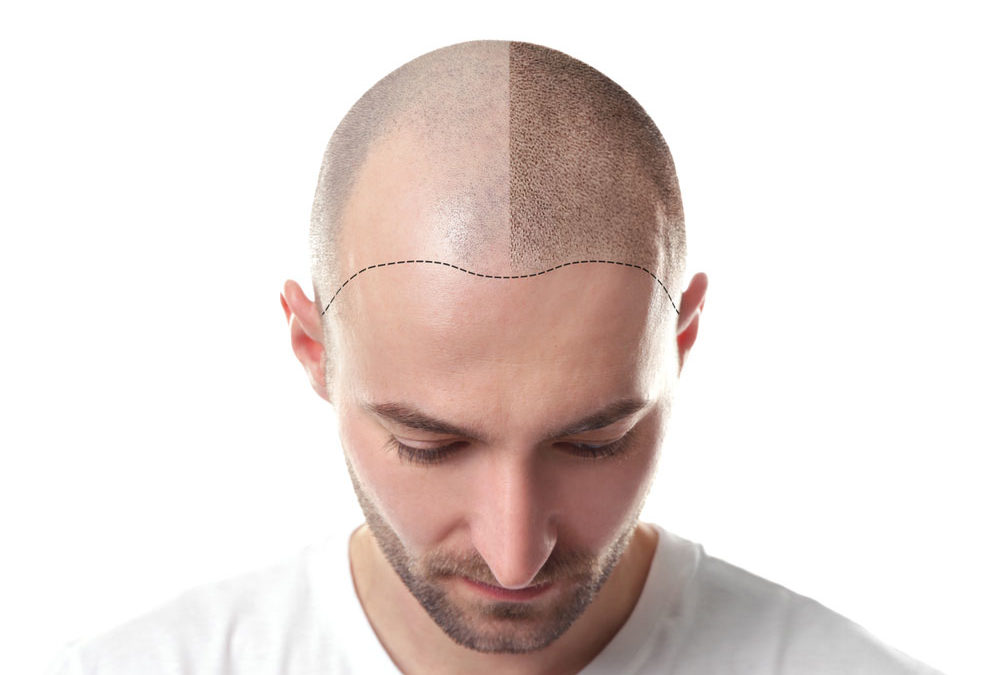 FUE Hair Transplant